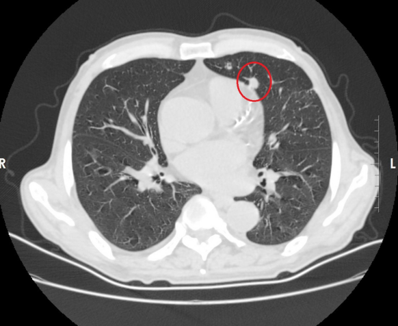 【抚宁中医健康科普】带你解读CT报告里的“肺结节”