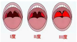 【抚宁中医健康科普】扁桃体是“切”还是“留”？一篇讲清手术指征与等离子微创优势